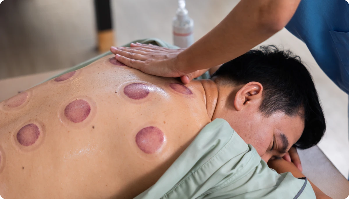 Cupping marks on man's back during massage